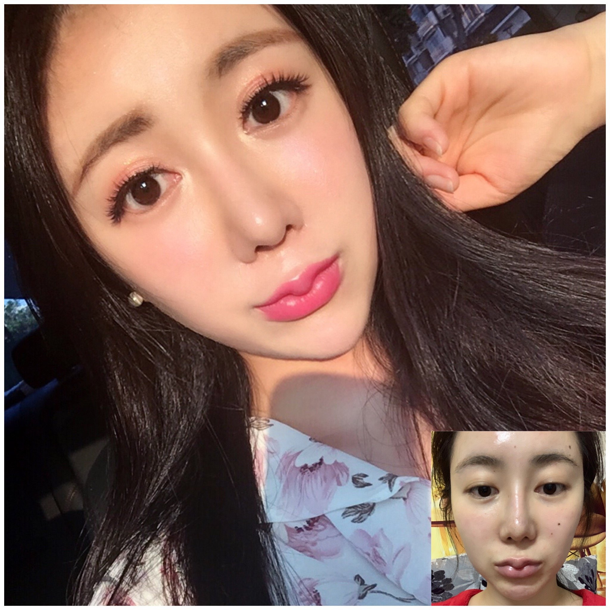 我的盒型鼻头真好看#刚做完鼻子的时候鼻头岂止盒型_圈子-新氧萌葺