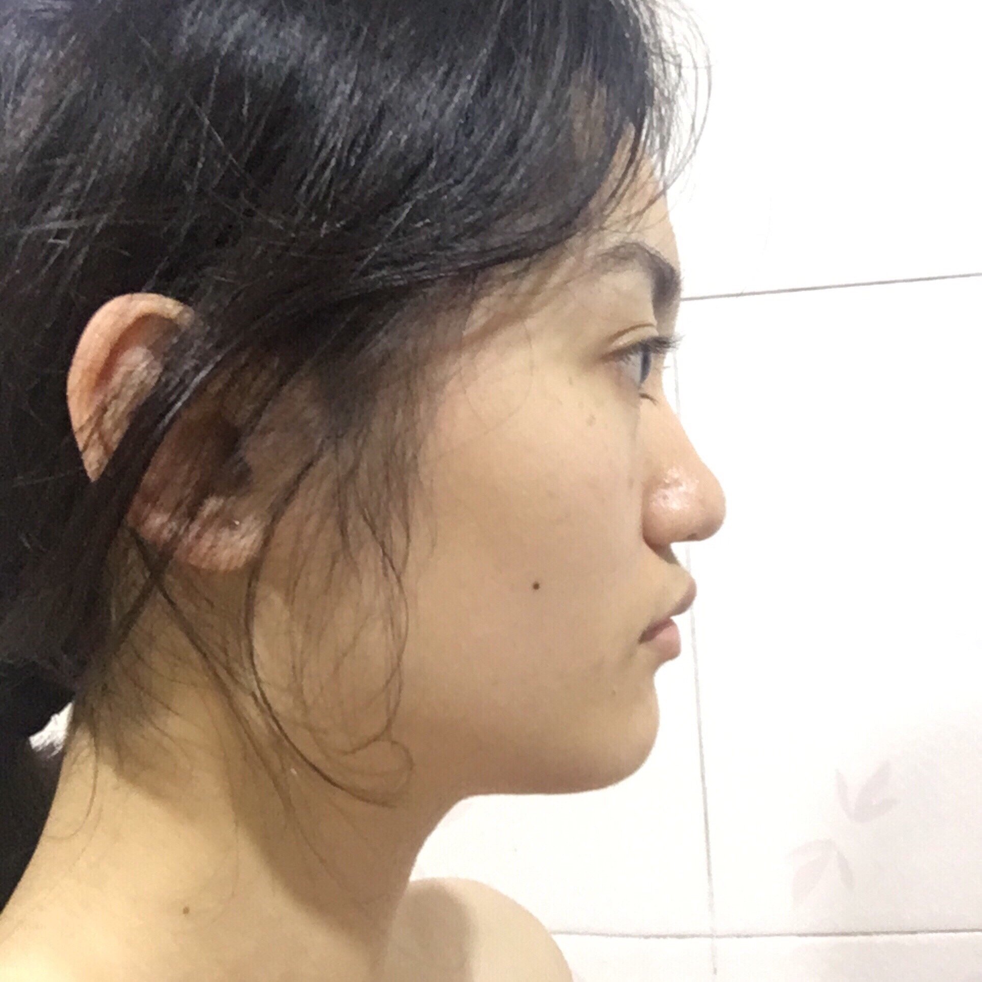 新氧看脸天团#颧骨外扩,鼻基底凹陷,五官轮廓不够_圈子-新氧美容整形