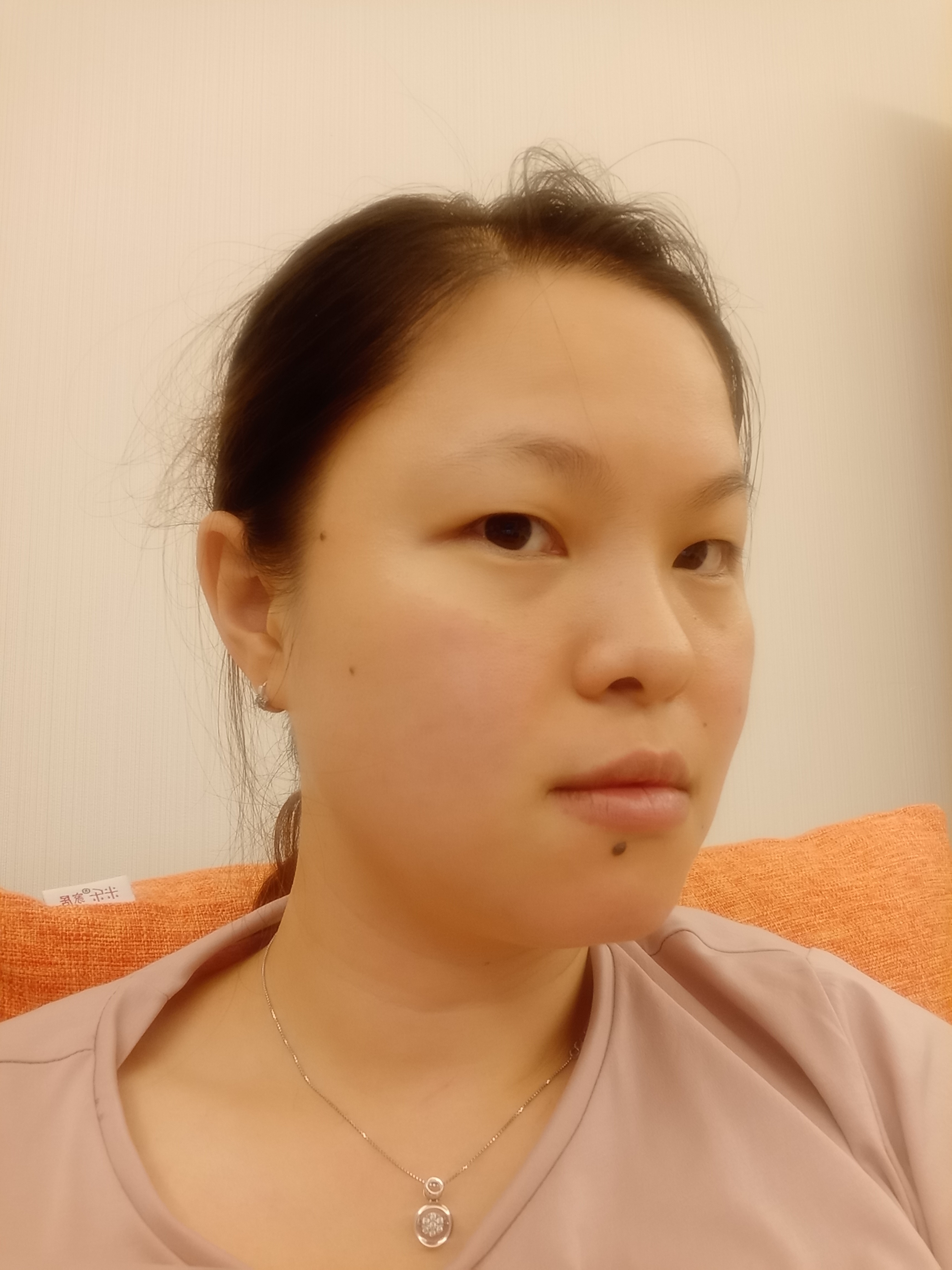 1.素颜照:正侧_圈子-新氧美容整形