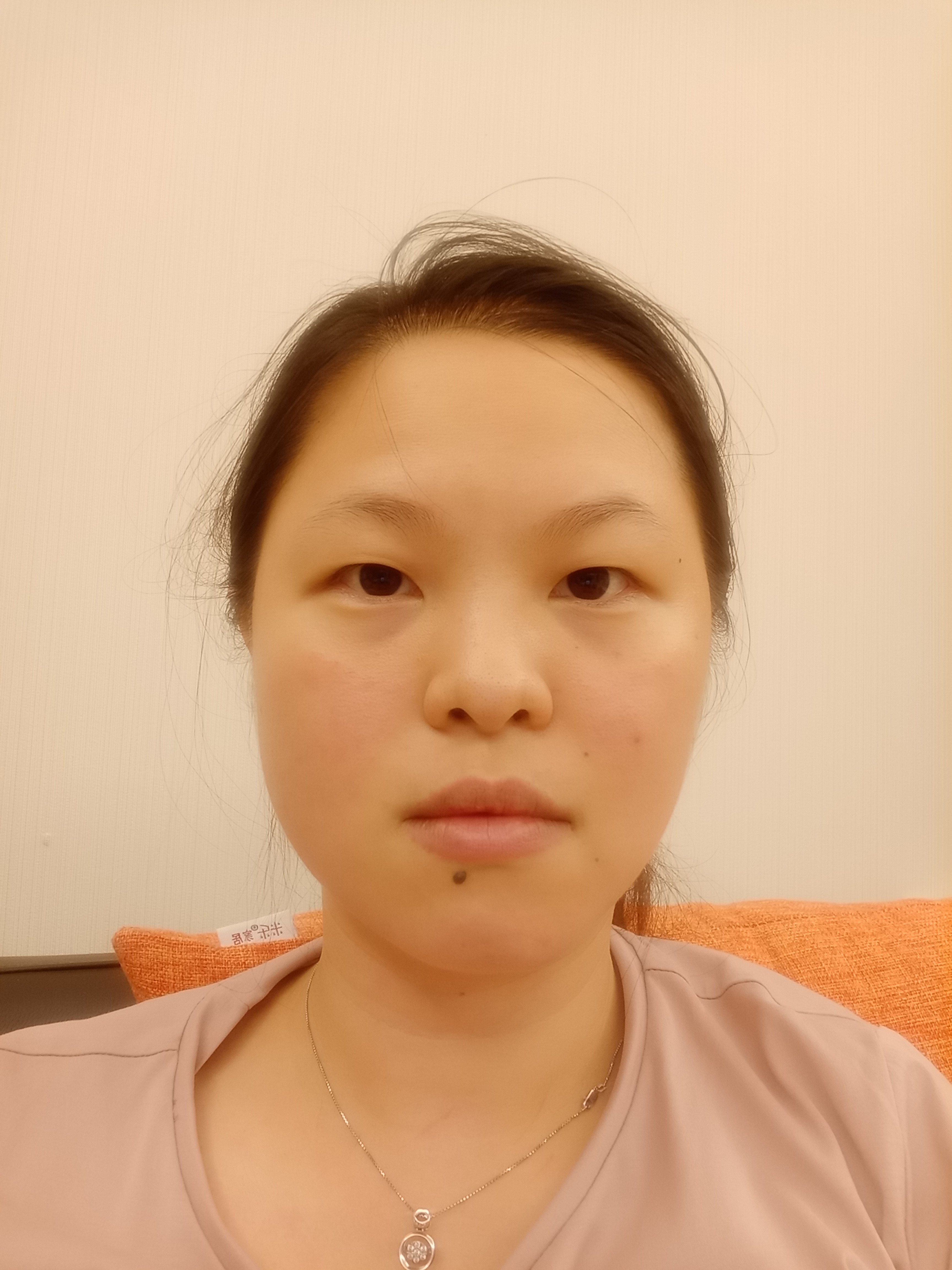 1.素颜照:正侧_圈子-新氧美容整形