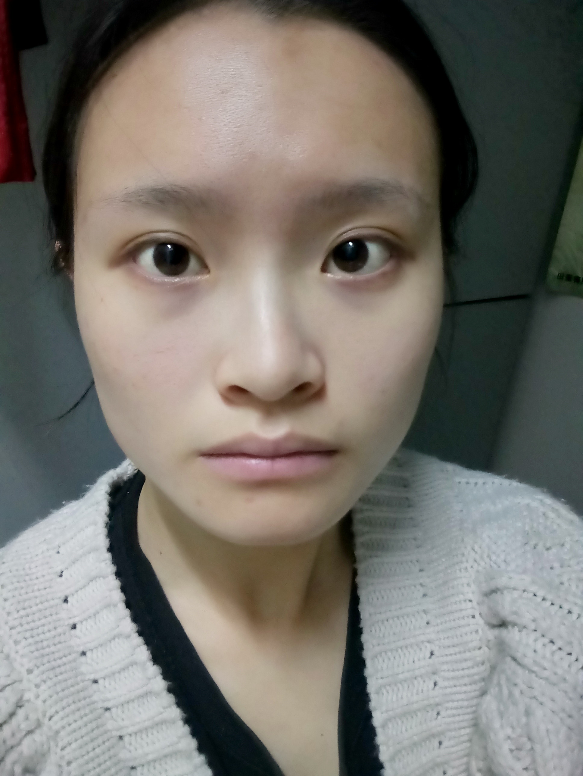 22岁女身高172体重55方脸 方下巴 没下巴 鼻_圈子-新氧美容整形
