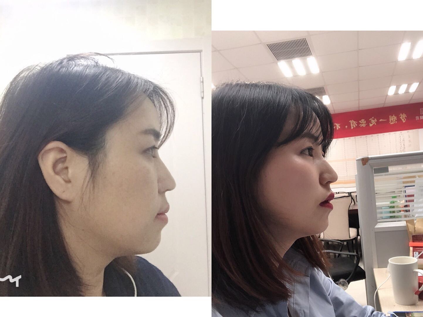 整牙前和整牙后的颌面对比,原来有点地包天,现在效果_圈子-新氧美容