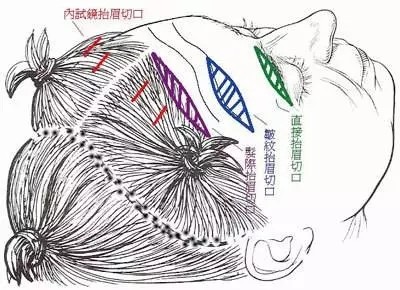 线雕提拉和拉皮手术有何区别?1、方式不同。