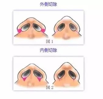 鼻翼缩小术选择内切还是外切?