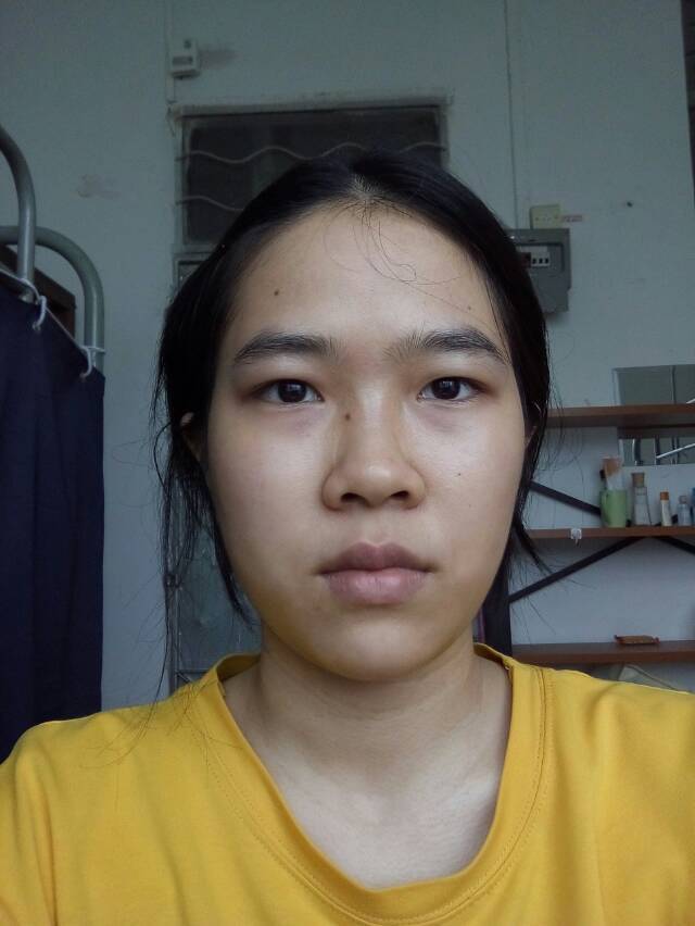 鼻子条件不好,鼻翼宽鼻梁塌,正面还有一点露鼻孔,整个人都显得很不