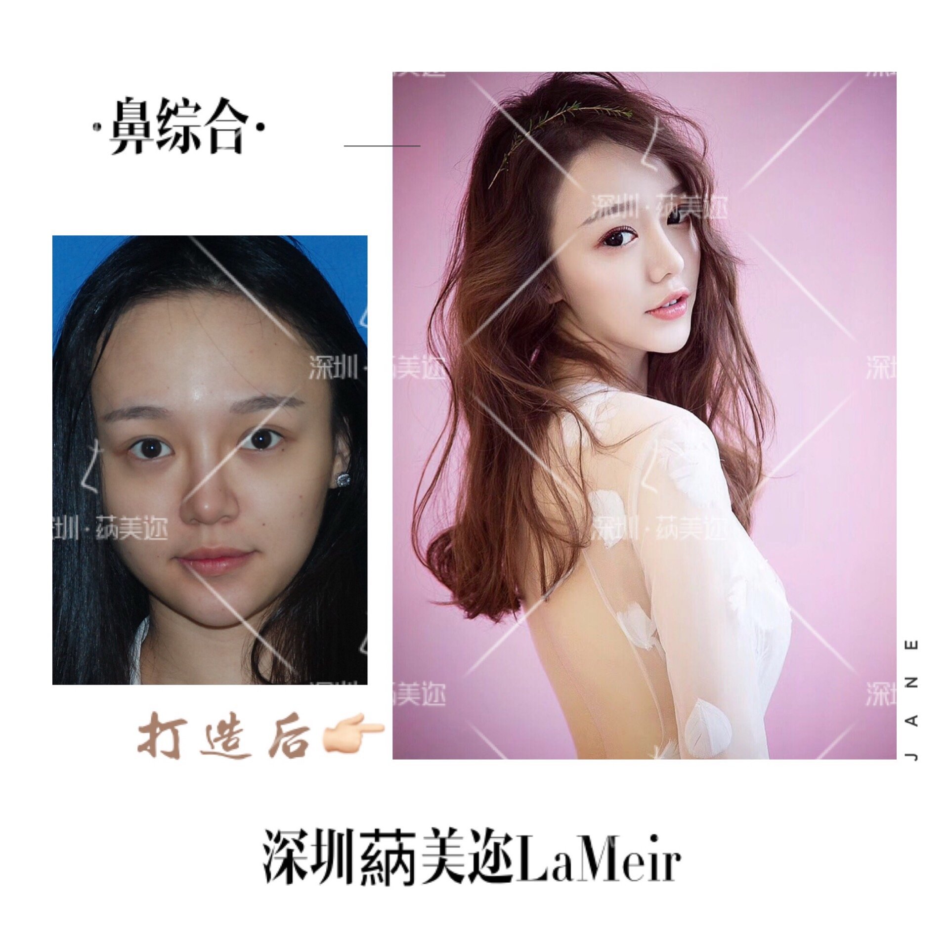 做完鼻小柱会不会留疤 新氧美容整形