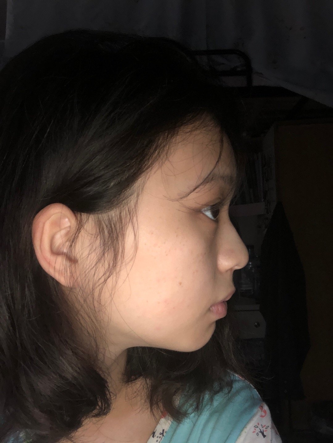 我是上面门牙部分有点突出,感觉导致了我下巴后缩用牙套会不会变好哇