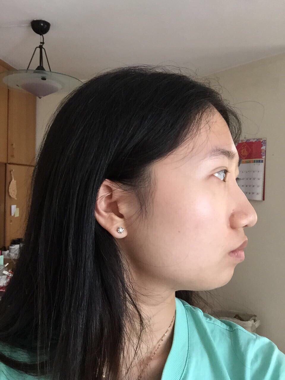 迷死氧鼻基底凹?凸嘴?下巴后缩?侧面不好看,问题_圈子-新氧美容整形