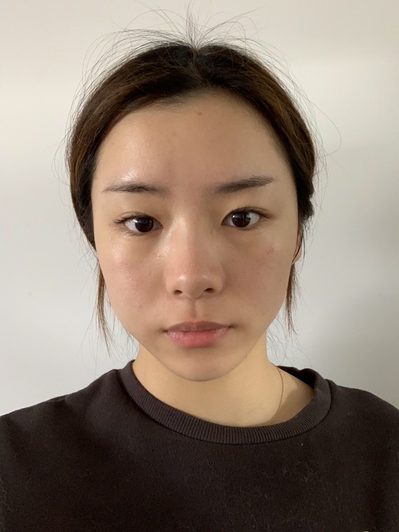 鼻翼缩窄是一项万能术式吗上