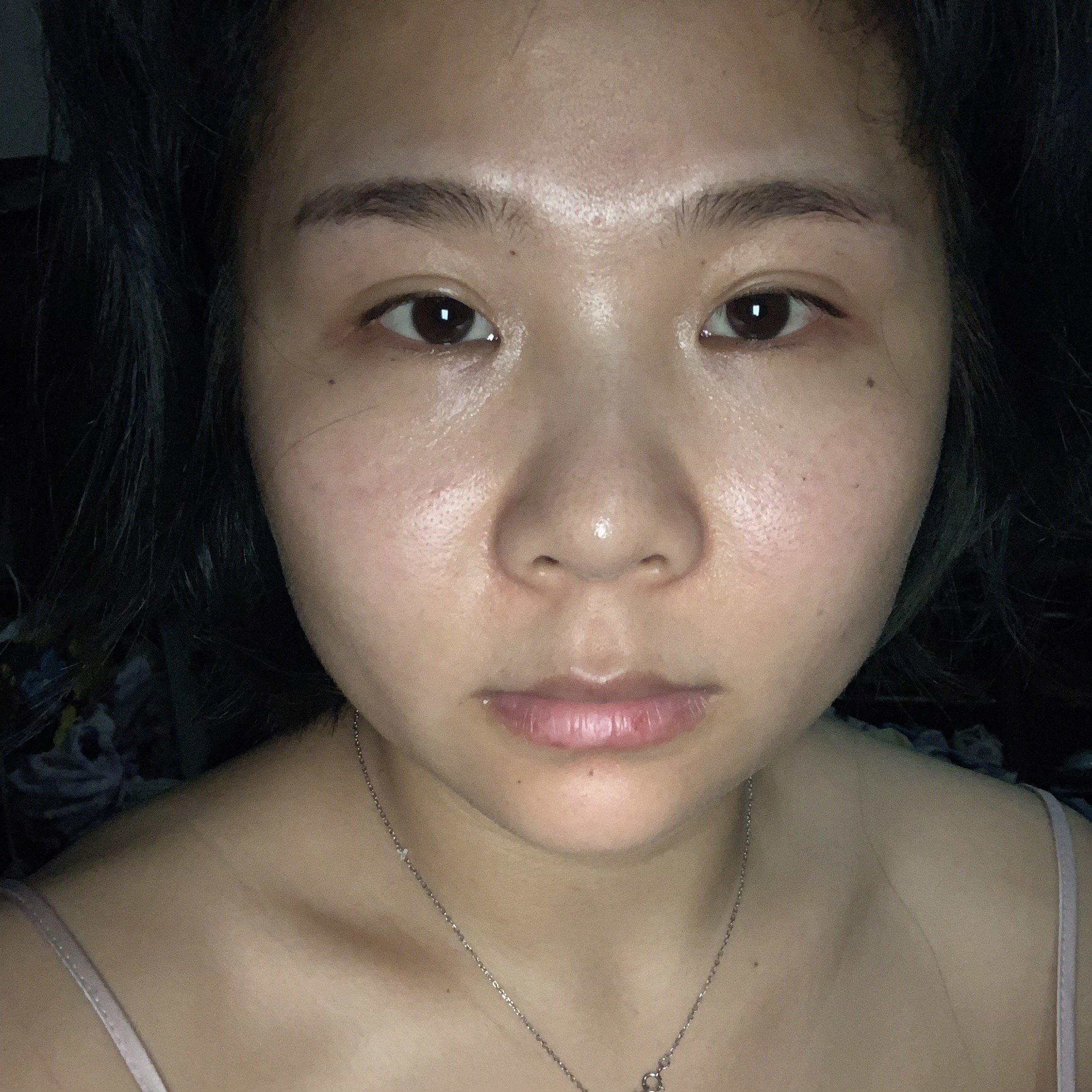 脸歪又大特别显胖下颌骨特别宽割了个双眼皮还特别失败_圈子-新氧美容