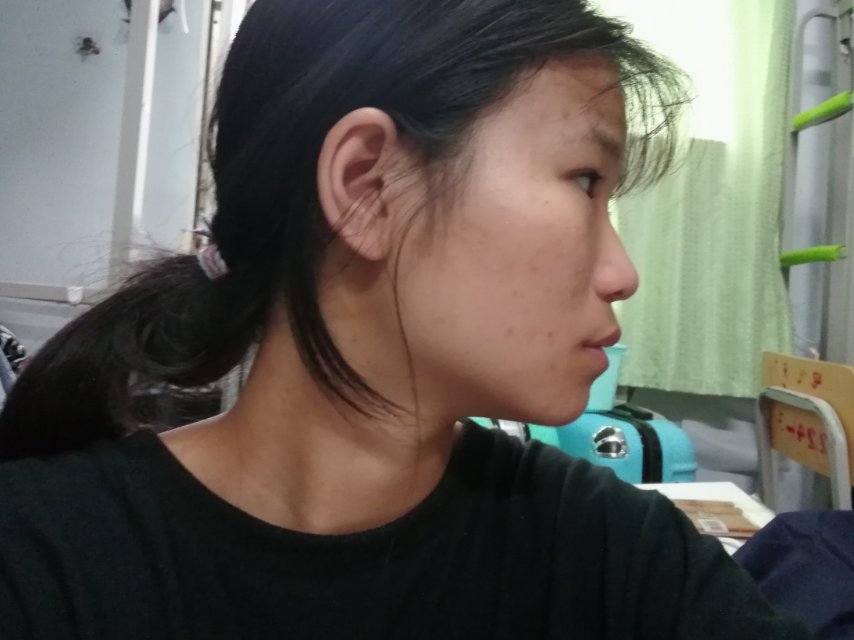 救救孩子吧,鼻子扁还塌,颧骨大,面中部凹陷,凸嘴q_圈子-新氧美容整形