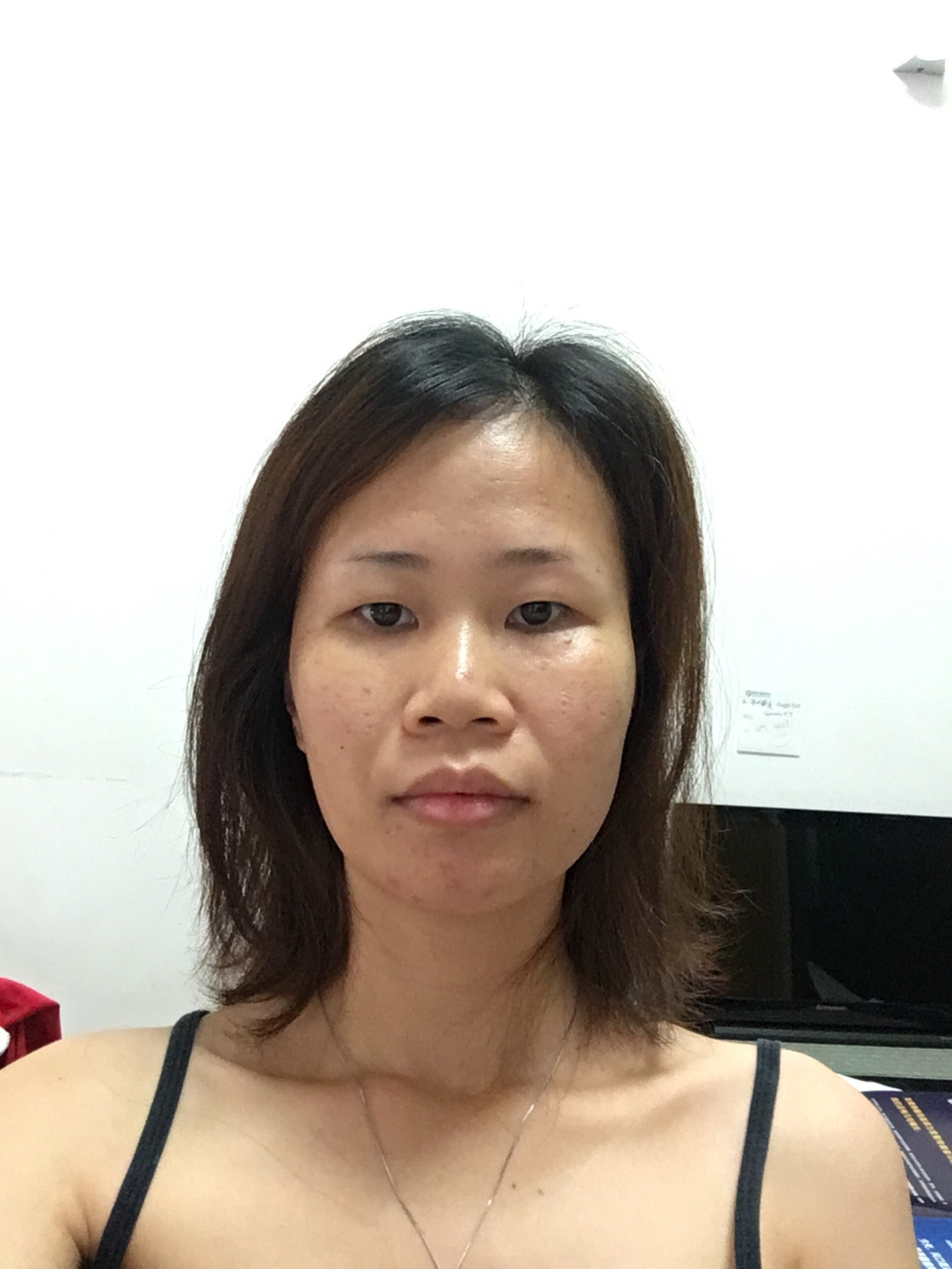 自我判断有以下的问题:1,首先法令纹好严重,作为一_圈子-新氧美容整形