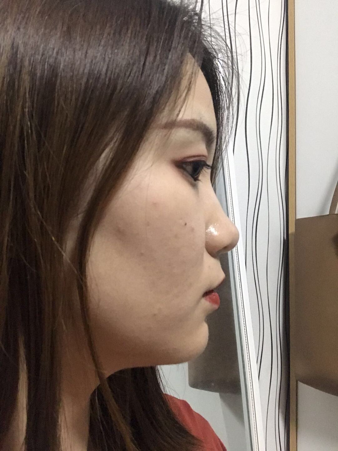 呜呜呜我来投稿了鼻基底凹陷完全没鼻梁鼻头还那么大从_圈子-新氧美容