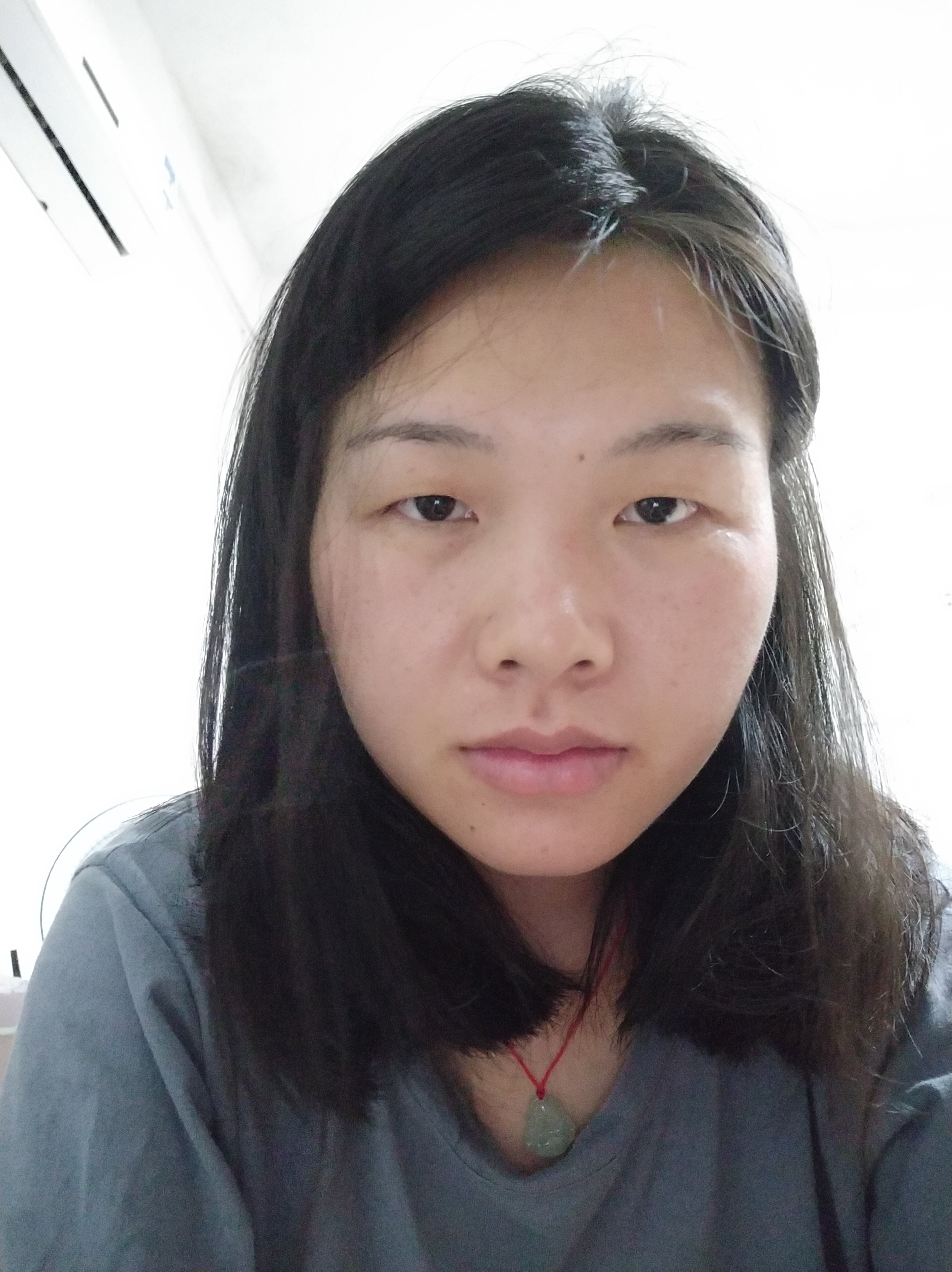 24岁的年纪,40岁的脸,单眼皮眼睛小眼皮下垂朝天_圈子-新氧美容整形