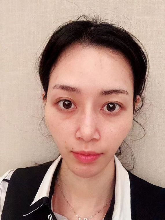 苏州探店-自体脂肪填充像我这样的干瘪脸如此增肥更好!