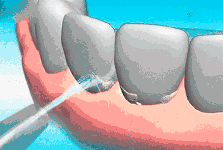 整个预防护理型洁牙的过程 一共包括4个步骤: -step 1- 洗牙之