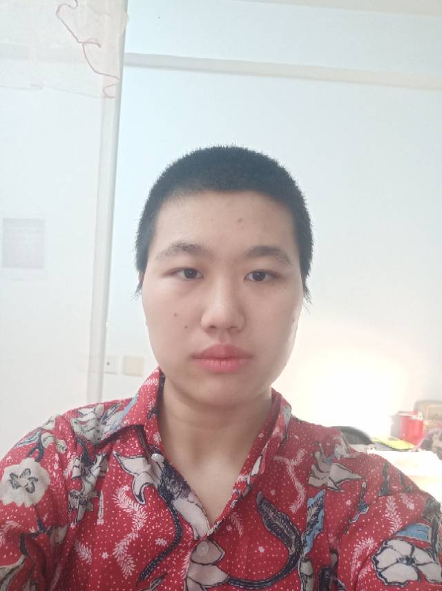 不足,太阳穴凹陷,颧骨外扩,头包不住脸巨丑,再加上发际线低,额头窄,炒