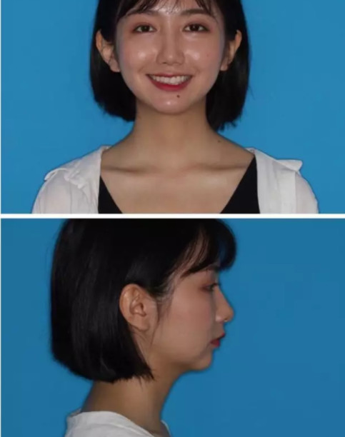 医生告诉我不用拔牙,我也在拔跟不拔之间纠结了很久