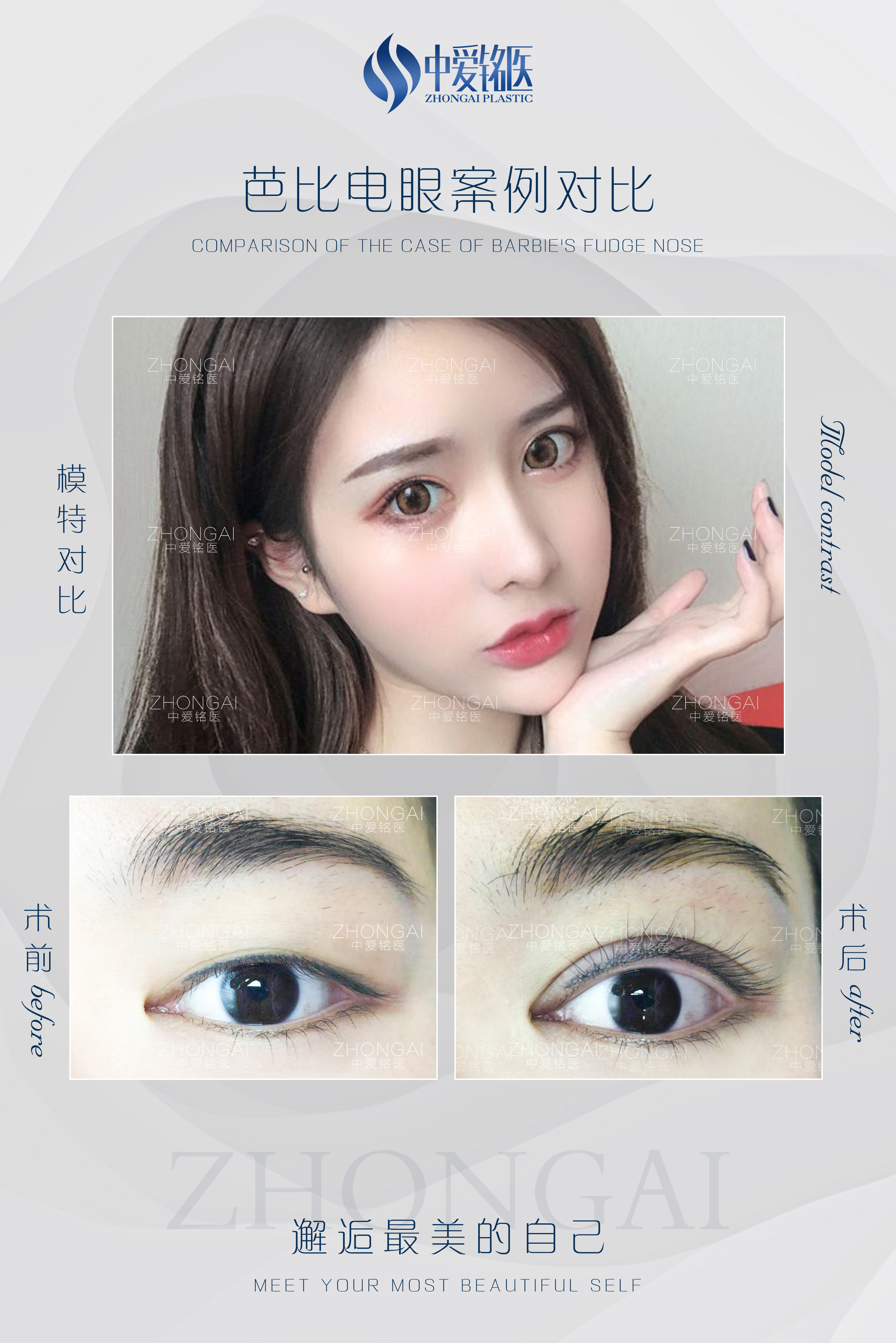 眼睑下至是什么跟开外眼角有什么区别吗