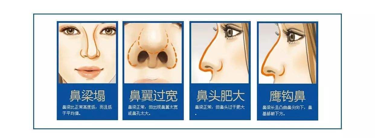 隆鼻对于相貌的影响有多大 新氧美容整形