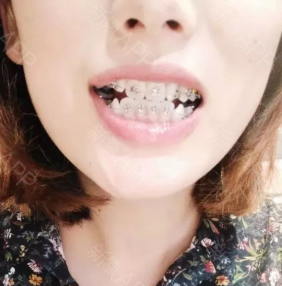 整牙对脸型有改变.牙套戴388天就结束了,效果还是很满意的