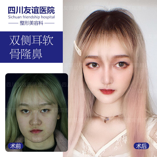 有过敏性鼻炎能不能两隆鼻 新氧美容整形