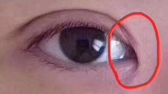 想知道眼睛下面的沟是泪沟还是由于内眦造成的?怎么解决