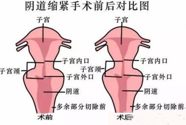 阴道紧缩术后不能顺产吗 会对生育有什 新氧美容整形