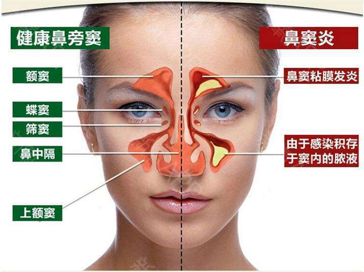 想做隆鼻 但是我有鼻炎可以做鼻子吗 新氧美容整形