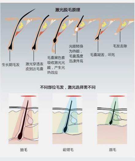 激光脱毛能维持多久 有没有什么后遗症 新氧美容整形