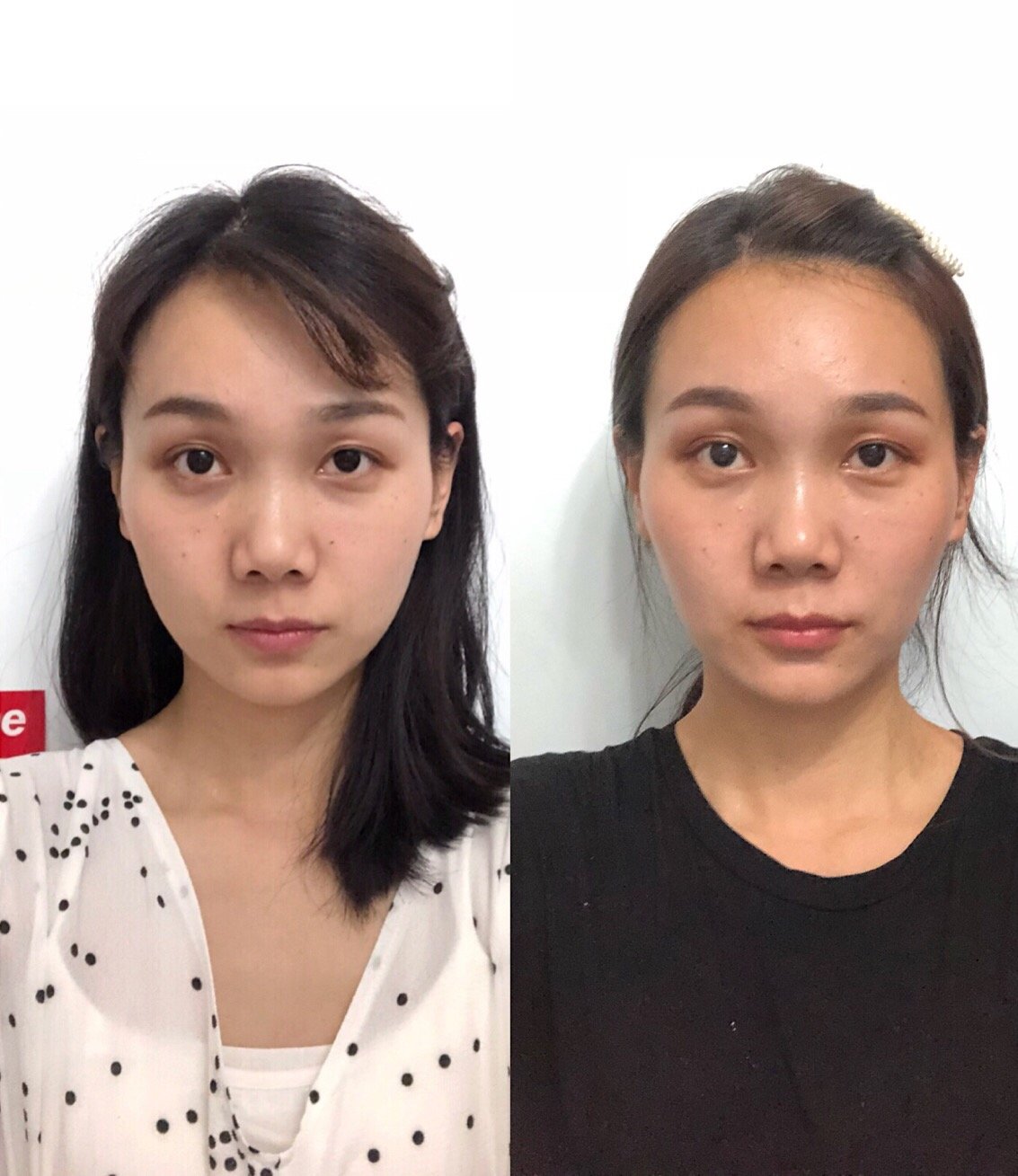 我本来正好但是打完瘦脸针脸颊凹陷了可咋整啊还能恢复吗