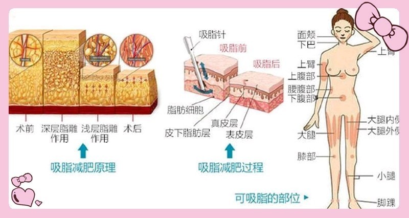 130斤的人去抽脂减肥合适吗 他们说抽脂 新氧美容整形