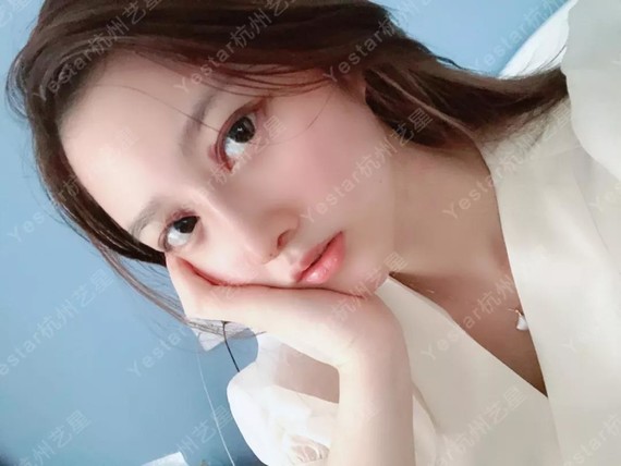 术后4天 鼻子明显改变,气质提升,自信最美