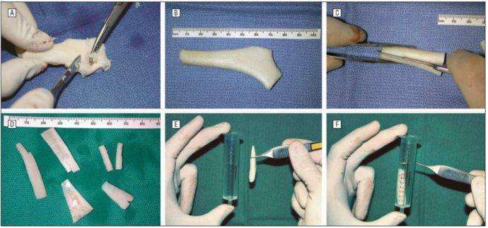 肋软骨隆鼻后剩下的肋骨会不会空落落的没地方搭住?