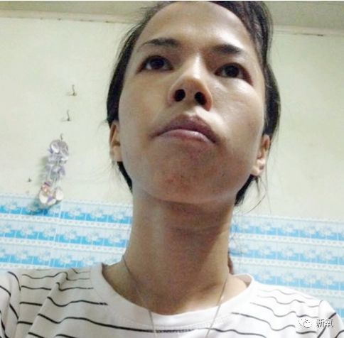 哈喽仙女们好,今天又是对比图超吓人滴海外整形日记_圈子-新氧美容