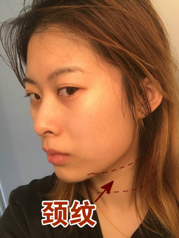 整个下颌面突出怎么办?