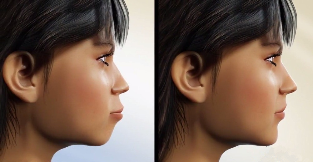 眼珠凹陷 上眼眶骨和侧面眼骨凸出 由 新氧美容整形