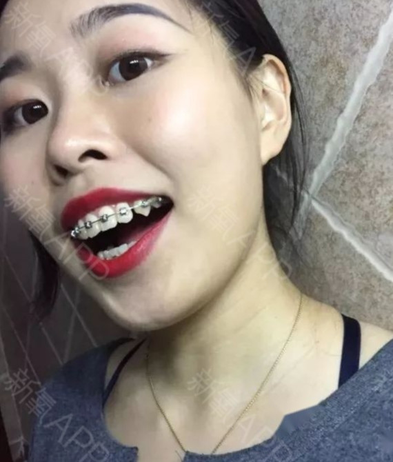 2017年5月25日正式成为小钢牙.