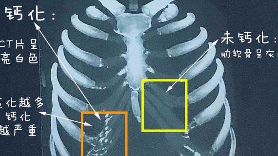 肋软骨钙化是什么钙化了是不是就不能做肋软骨隆鼻