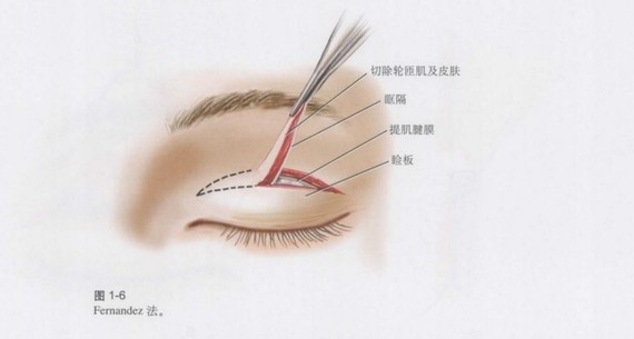 常见的重睑术式