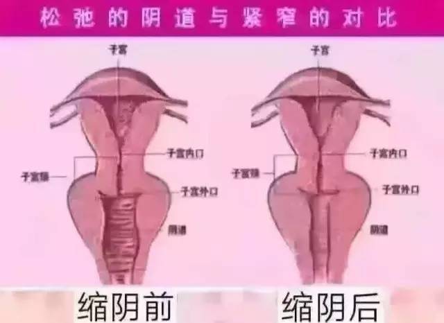 阴道紧缩手术为什么刚生完小宝宝的妇女不能做?