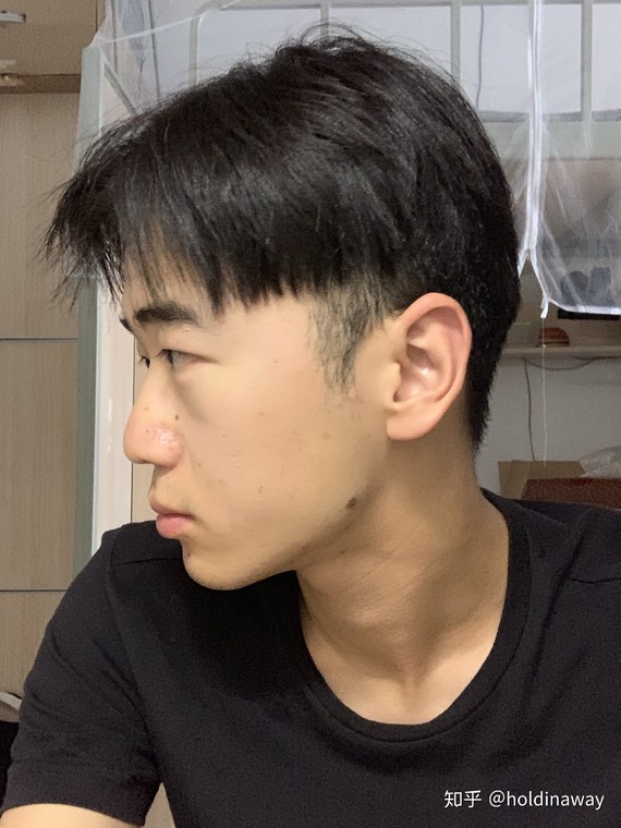 前方高能预警!其实从正面照也能略微看出端倪,上颌面整体凹陷.