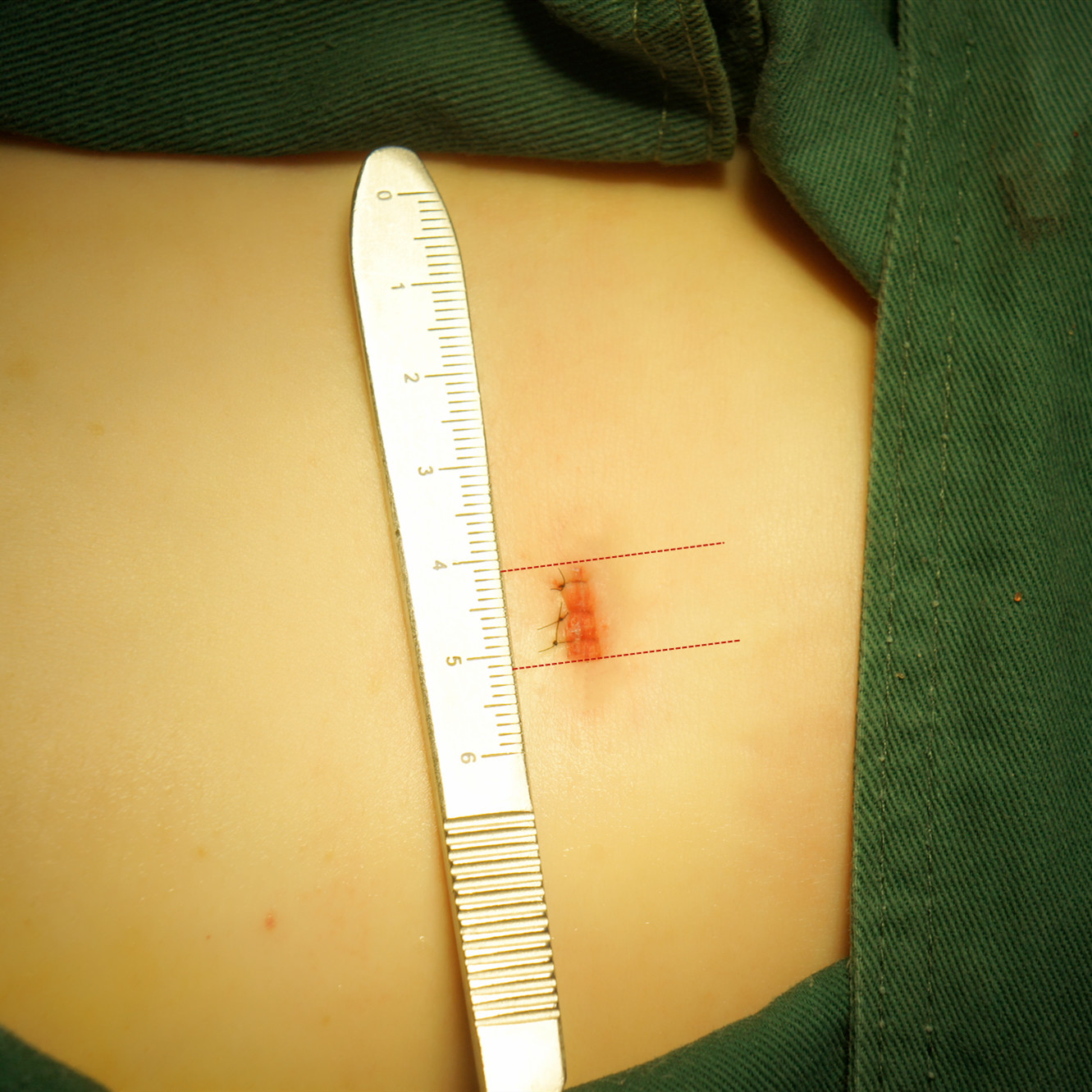 你好,这块是完全不会有影响的,并且取肋软骨还跟医生技术有关,如果