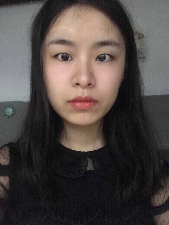 纵观所提供的照片来看,你的额骨曲度大,过于突兀了.