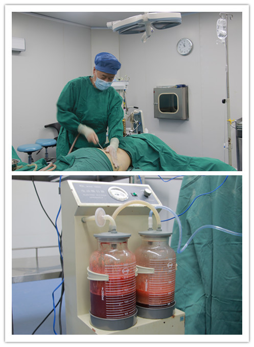 水动力吸脂真的是用水来当动力吗?