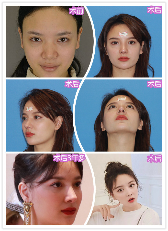 今天刚拆线感觉假体放在眉心中间了山根好高这是失败了吗还会在低点吗