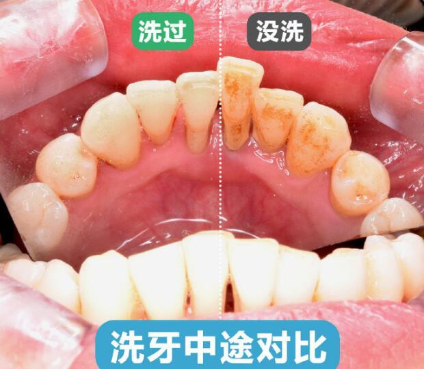 超声波洗牙对牙齿好吗 超声波洗牙后牙 新氧美容整形
