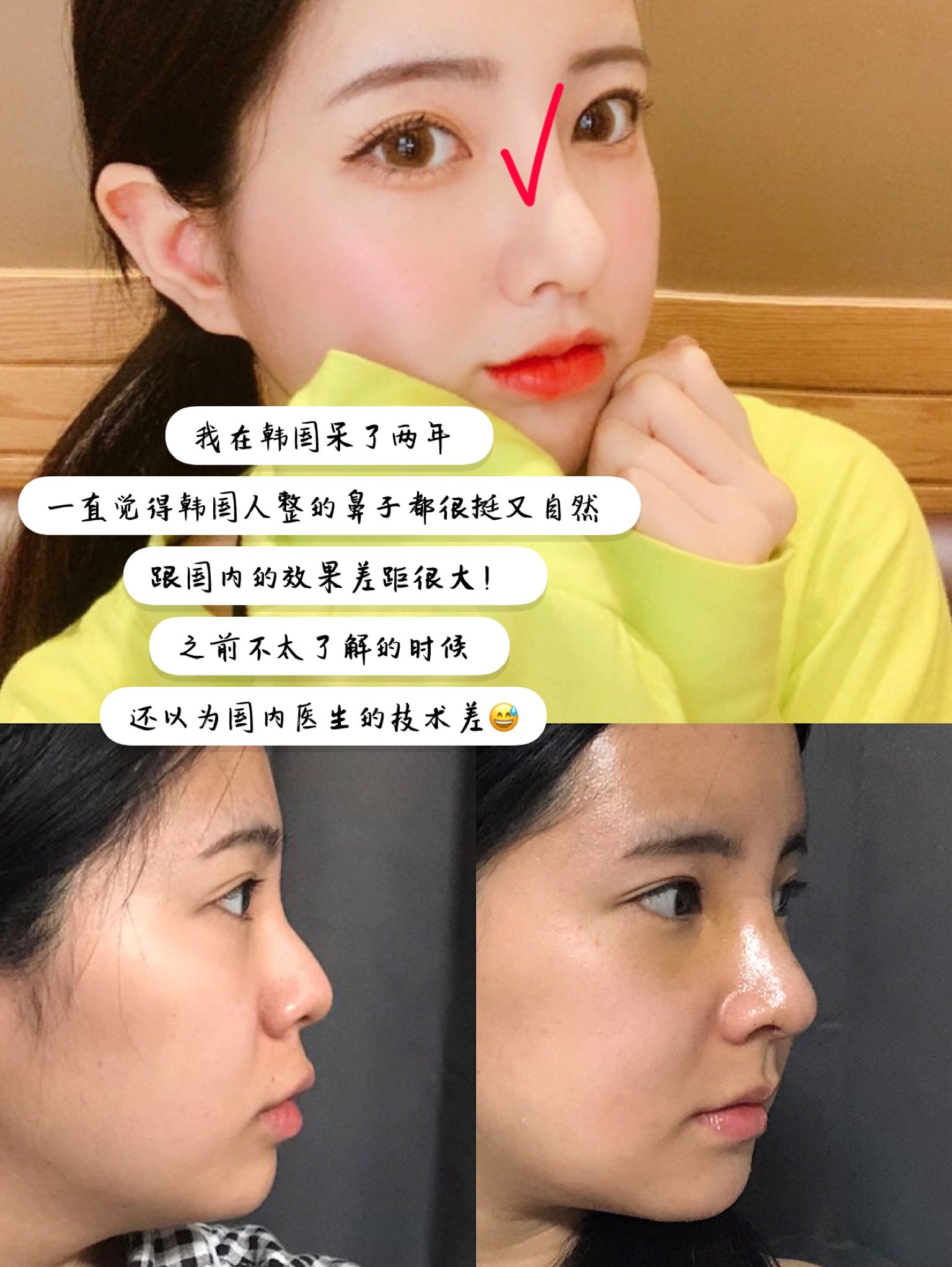 为什么韩国人整鼻子都自然逼真 国内的都那么吓人 圈子 新氧美容整形