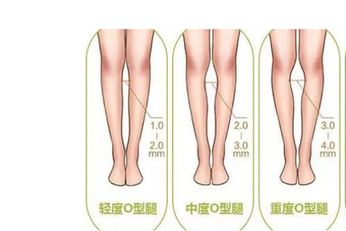 自体脂肪移植真的可以矫正o型腿吗 新氧美容整形