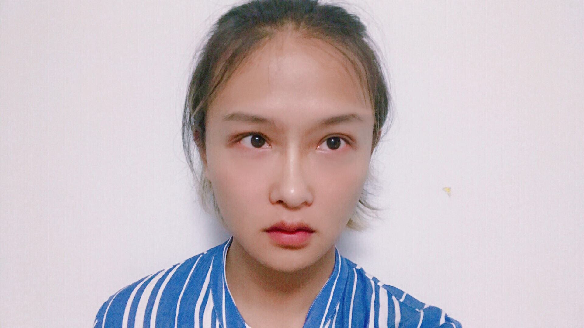 求看脸:正脸没有侧脸好看怎么破?重叠八重齿需要矫正吗?